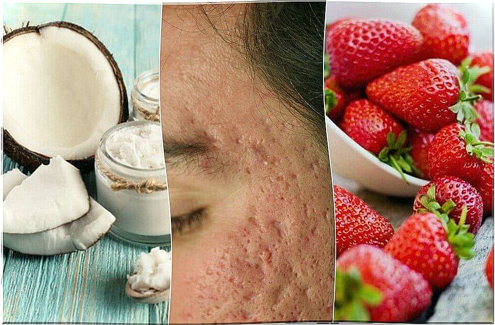 5 Homemade Treatments To Reduce Acne Scars