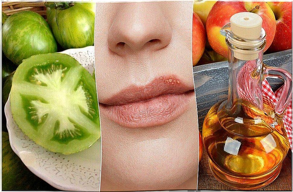 5 natural remedies to fight cold sores