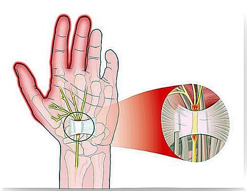 5 Tips To Relieve Pain From Carpal Tunnel Syndrome