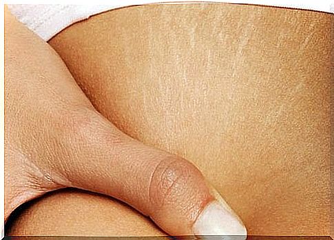 Appearance of stretch marks and treatments