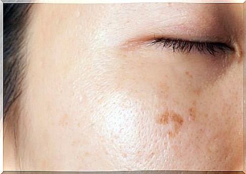 Skin changes and the appearance of spots