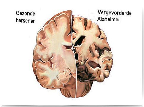 Alzheimer's: detecting the first symptoms in time