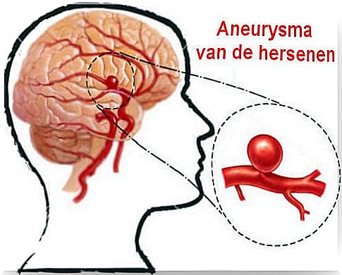 Brain aneurysm: what is it and how to prevent it