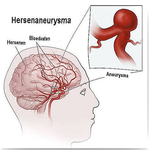 brain aneurysm