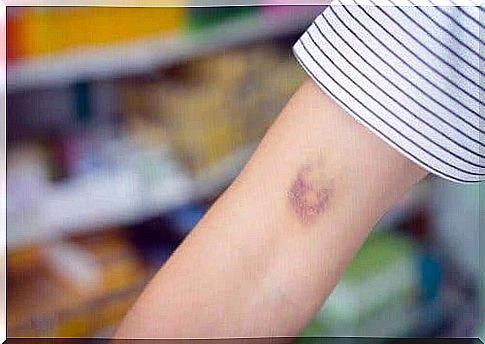 A person with a bruise