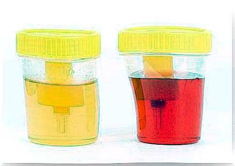 Hematuria: Symptoms and Causes