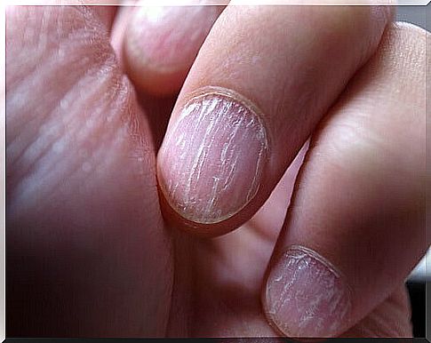 Damaged Nails