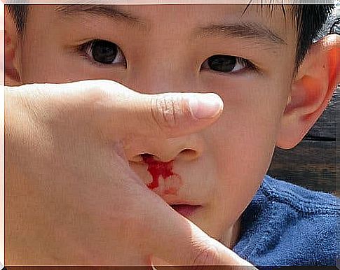 How to treat a nosebleed in children