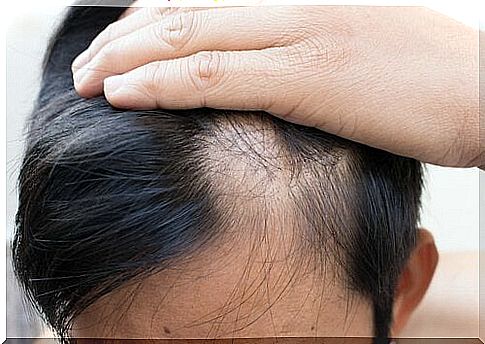 Alopecia areata