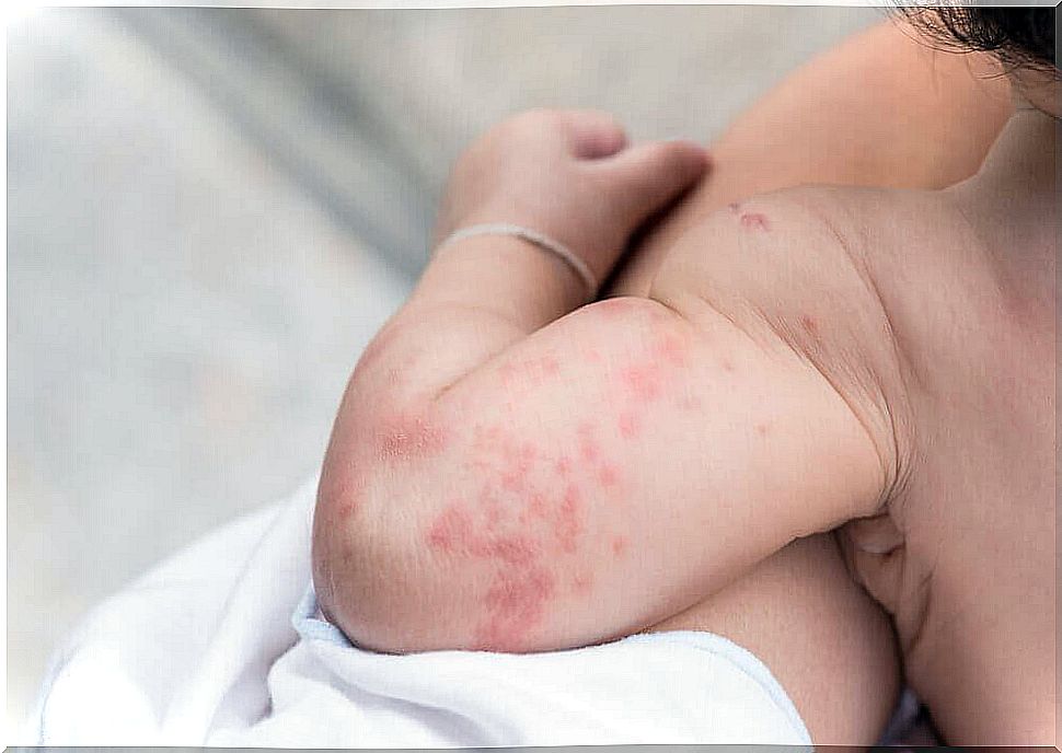 Is Heat Rash in Babies a Problem?