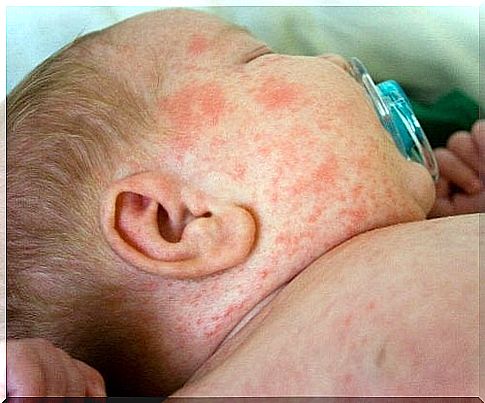 Heat rash in babies is not serious