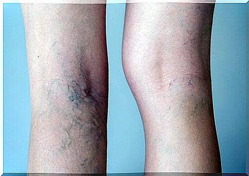 Varicose veins