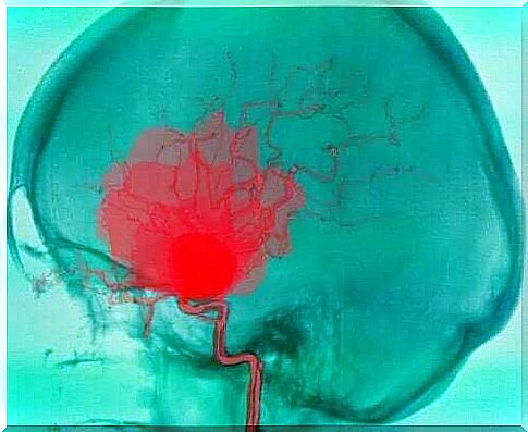 Subarachnoid and Subdural Bleeding