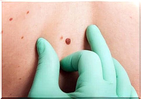 The ABCDE test for skin cancer, what does it mean?