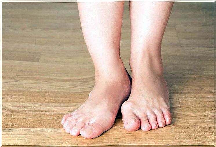 Tips to prevent the development of bunions