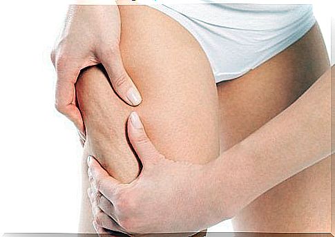 Treating Cellulite