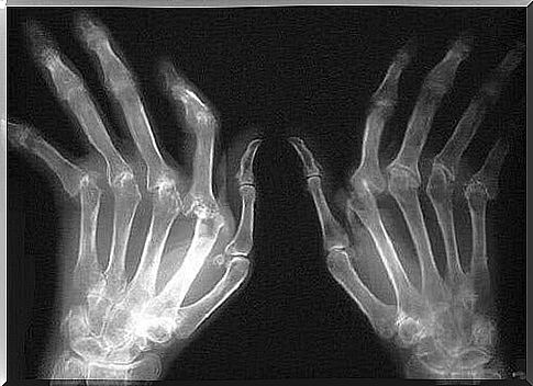 Treating Rheumatoid Arthritis Naturally