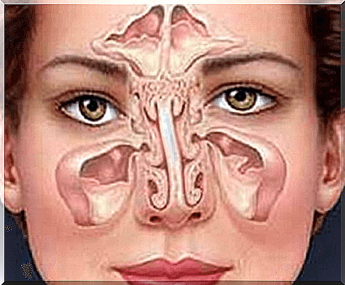 Treating Sinusitis Naturally