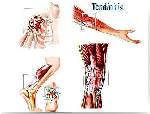 A view of tendonitis