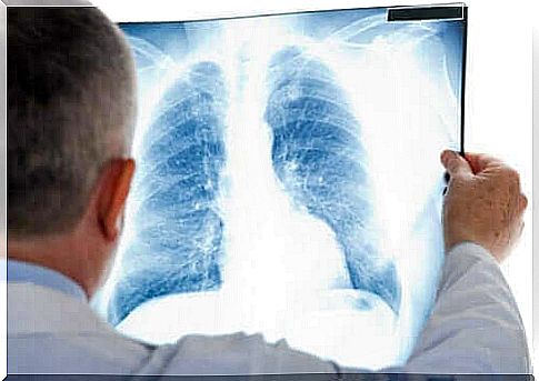 What is atypical pneumonia?